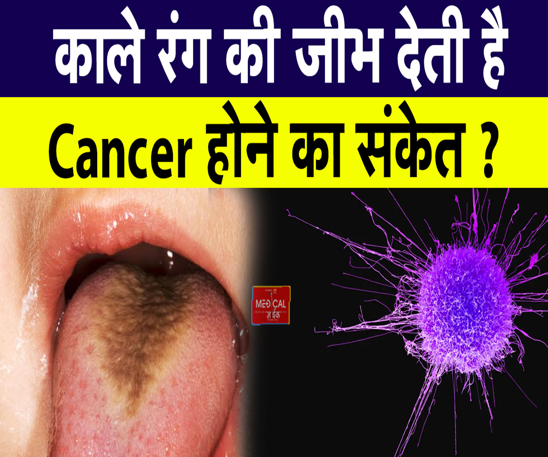 काले रंग की जीभ देती है Cancer होने का संकेत? अभी दूर कर लें ये कन्फ्यूजन