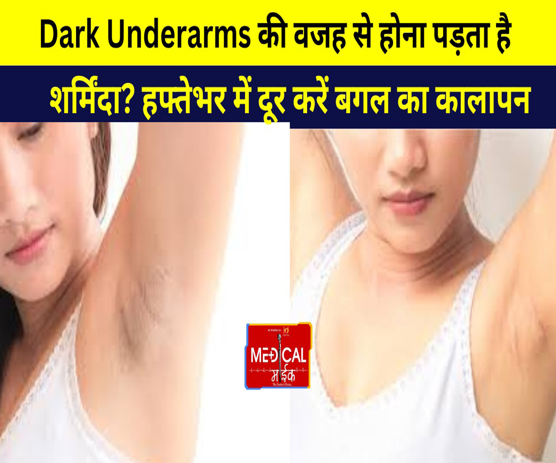 Dark Underarms की वजह से होना पड़ता है शर्मिंदा? हफ्तेभर में दूर करें बगल का कालापन