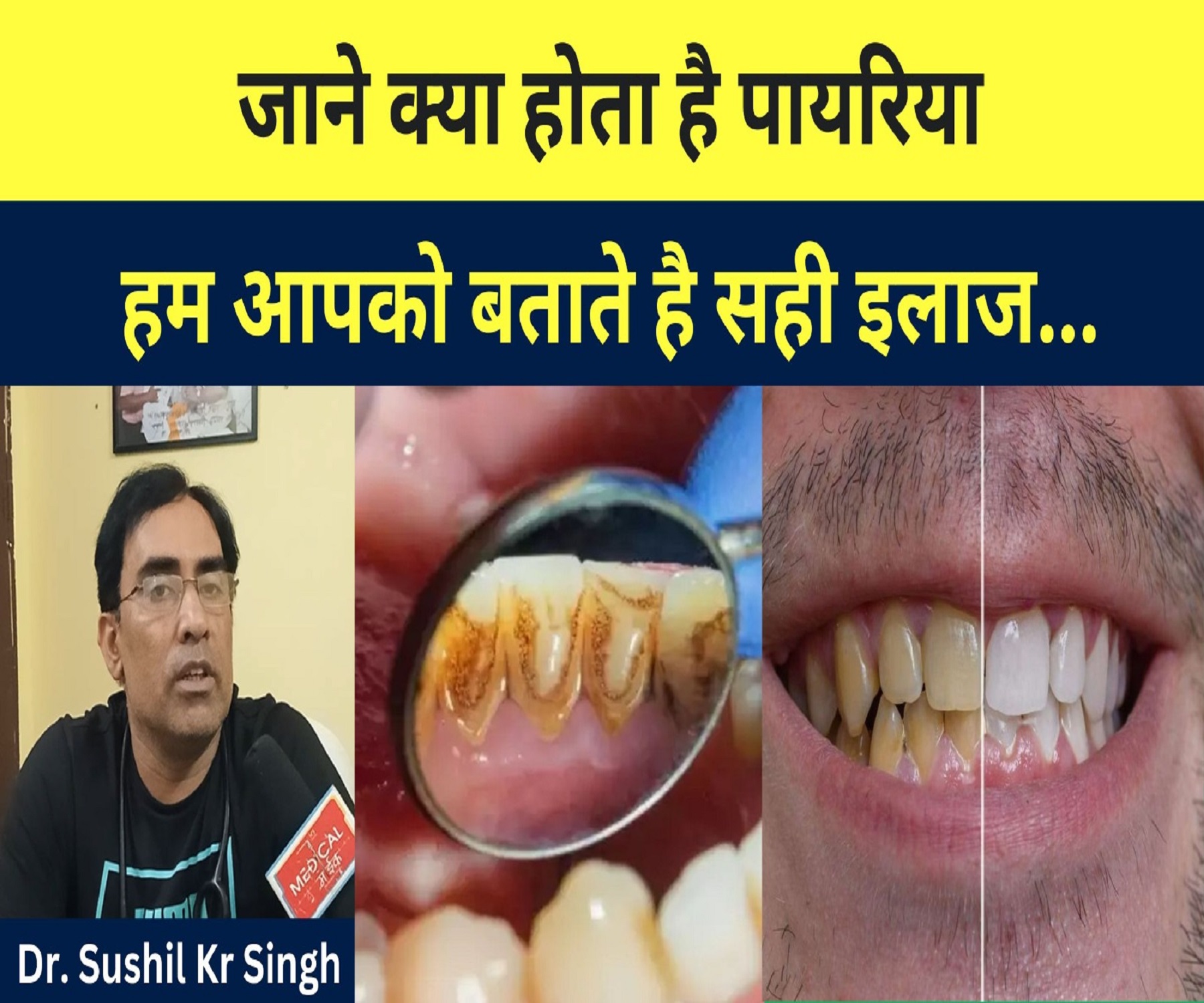 जाने क्या होता है पायरिया ? मुंह से बदबू आने का क्या है सही इलाज…Dr. Sushil kumar Singh