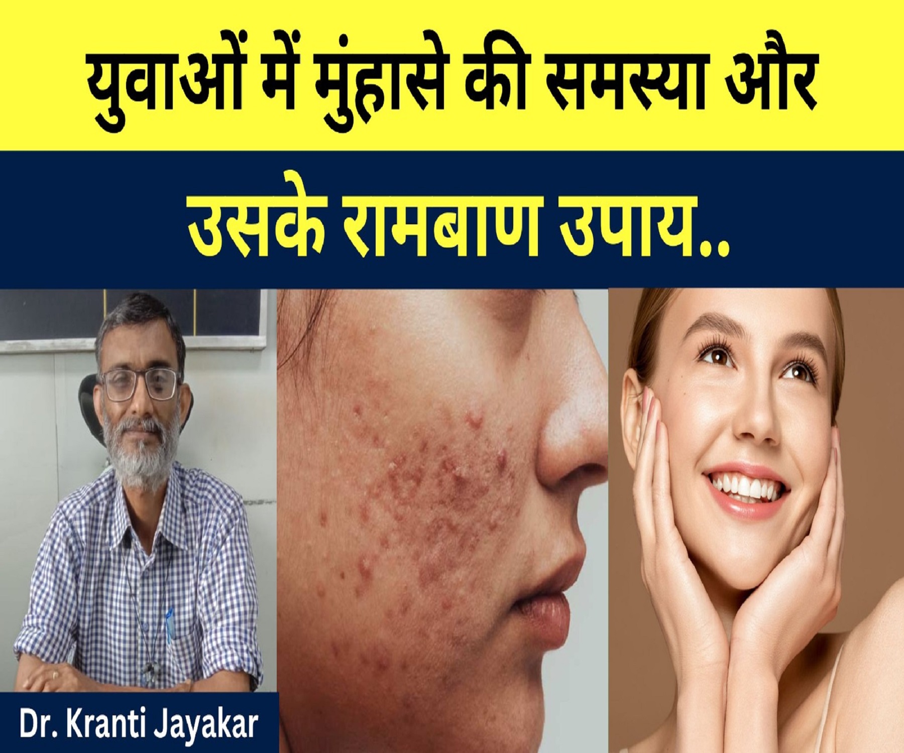 युवाओं में मुंहासे की समस्या और उसके रामबाण उपाय. Dr. Kranti Chandan Jaykar