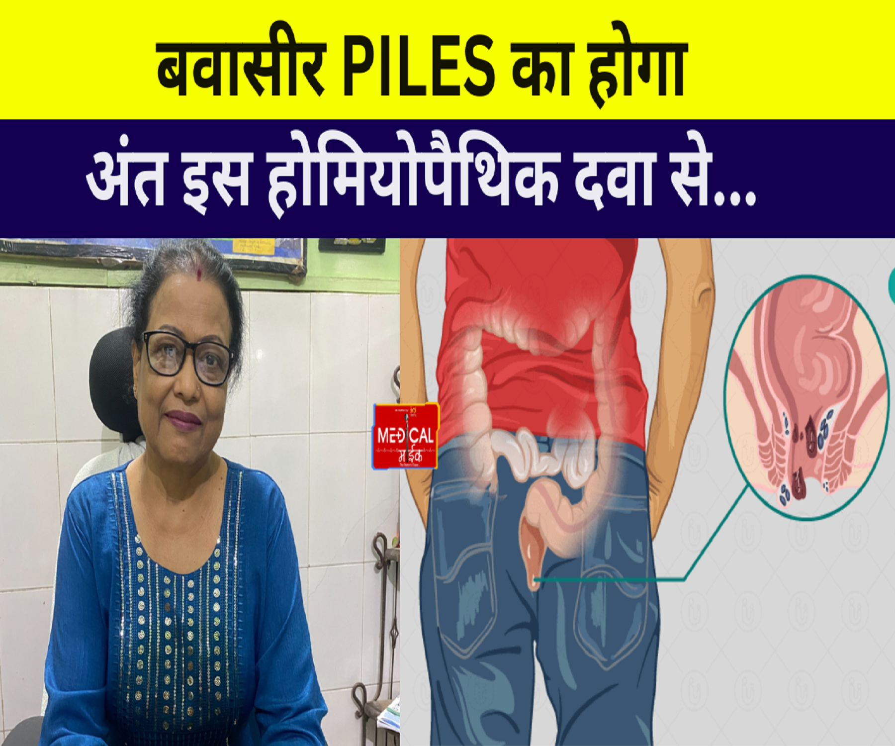 बवासीर (PIlES )का होगा अंत इस होम्योपैथिक दवा से …Dr. Anju Chandra