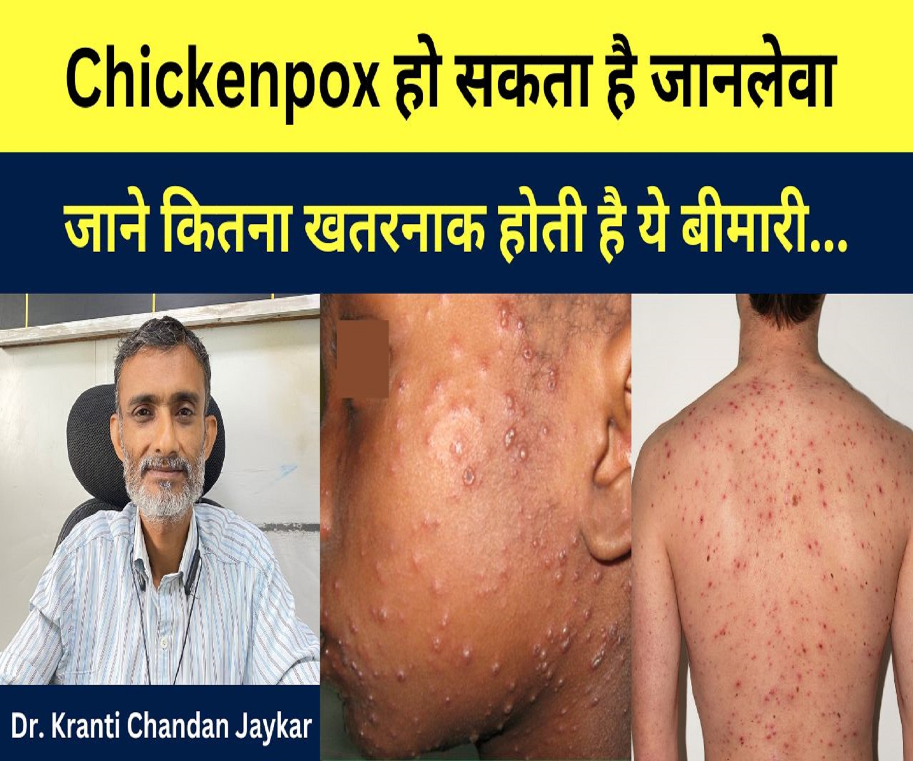 Chickenpox हो सकता है जानलेवा जाने कितना खतरनाक होती है ये बीमारी…Dr. Kranti Chandan Jaykar