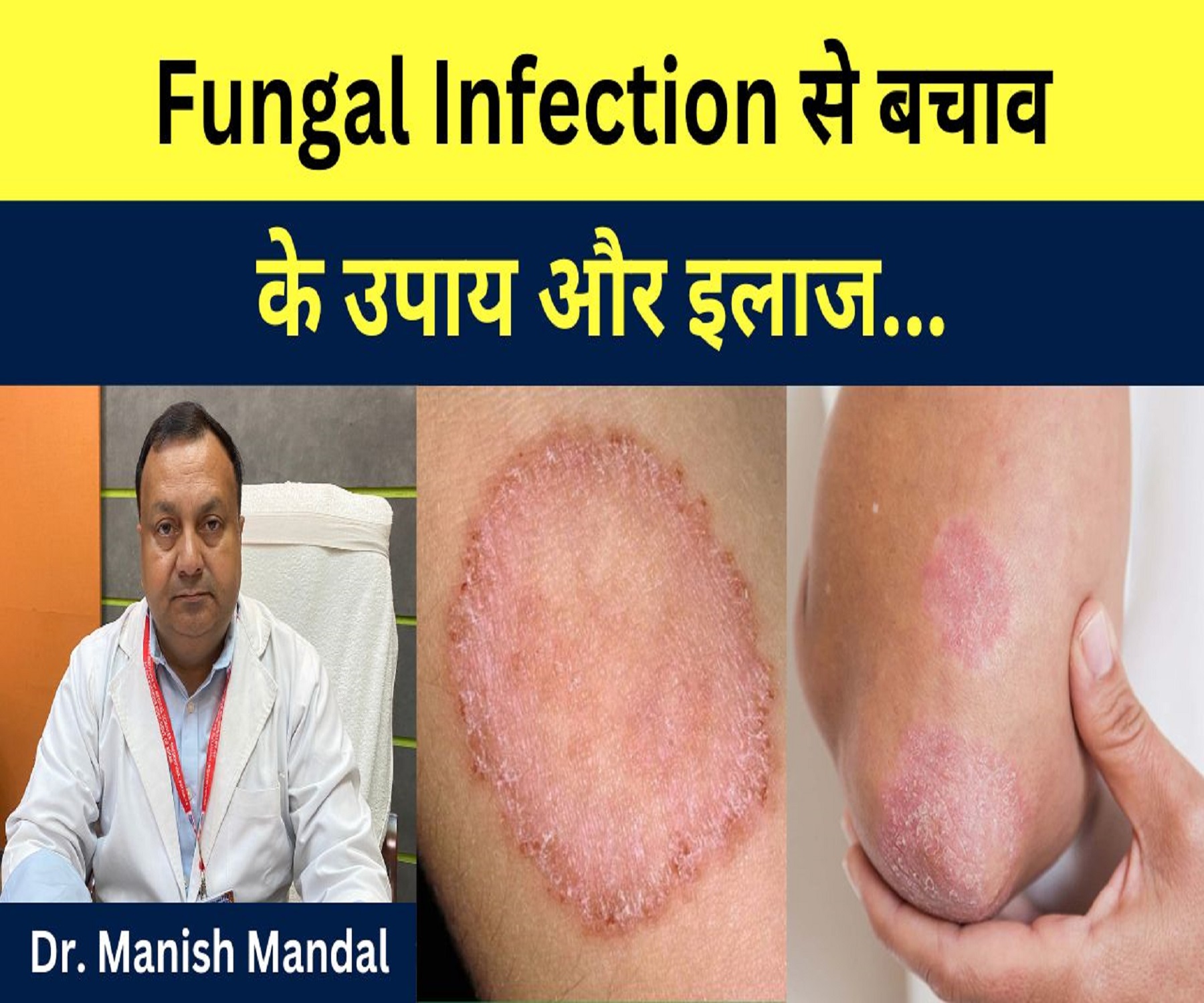 Fungal Infection से बचाव के उपाय और इलाज…। Dr Manish Mandal 