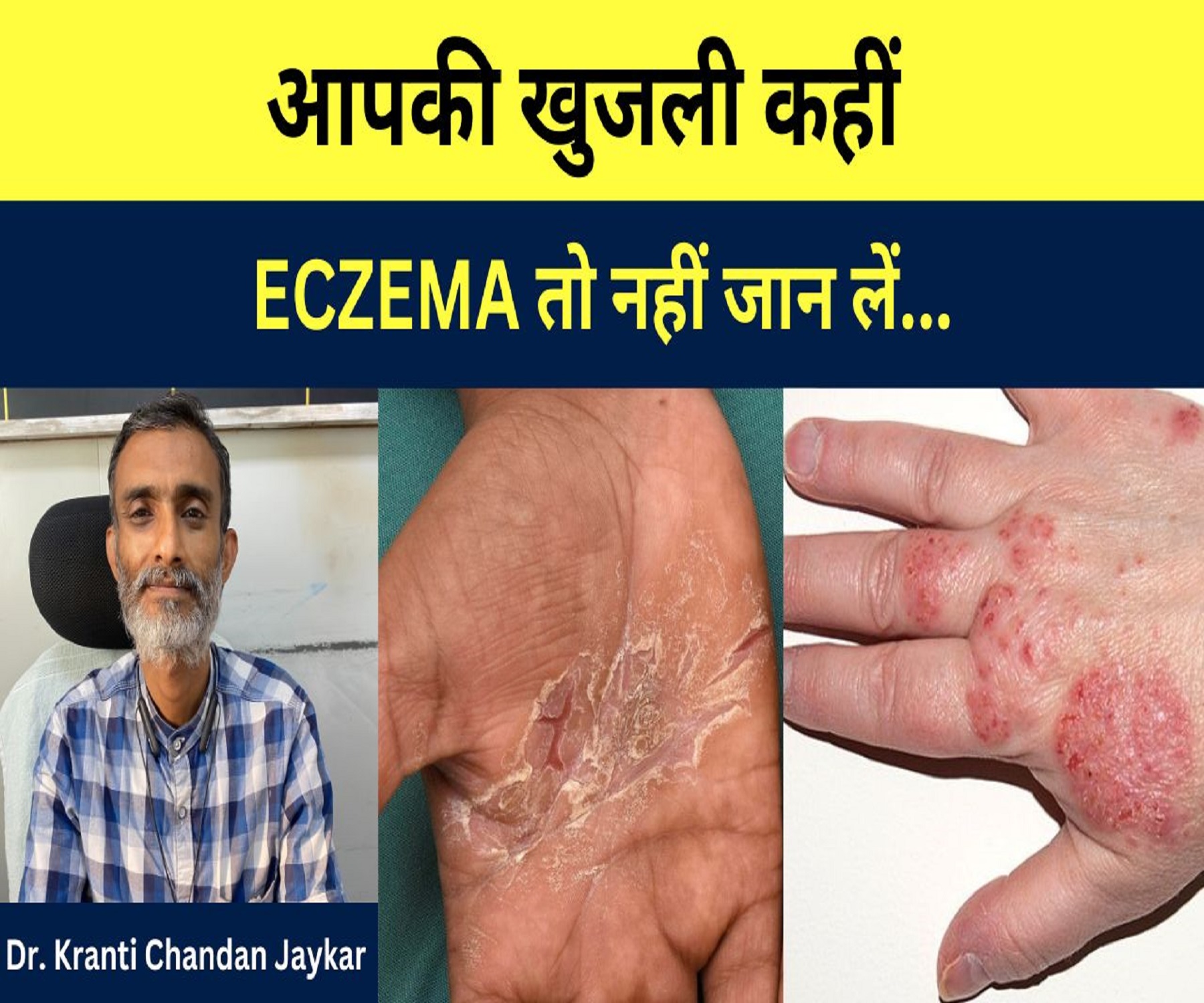 आपकी खुजली कहीं ECZEMA तो नहीं बता रहे हैं… Dr. Kranti Chandan Jaykar