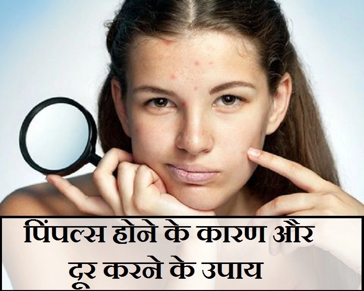 जानिए  मुंहासे होने के कारण Cause Of Pimple in Hindi